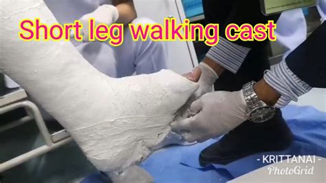 Sharingshort Leg Walking Cast Youtube