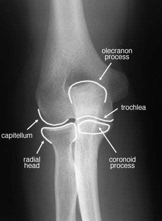 Radiographic Anatomy Of The Skeleton Elbow Anteroposterior Ap