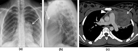 The Paediatric Thymus Recognising Normal And Ectopic Thymic Tissue