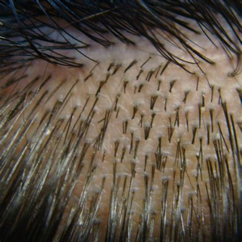 View Of Scalp Hair Demonstrating Follicular Units These Are Naturally