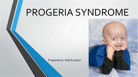 Progeria Syndrome