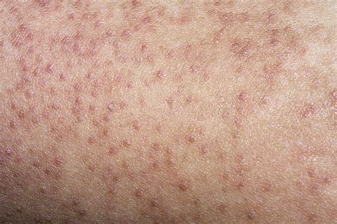 10 Home Remedies For Keratosis Pilaris Remedies Insider