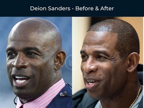 Black Celebrity Hair Transplants Before After Photos