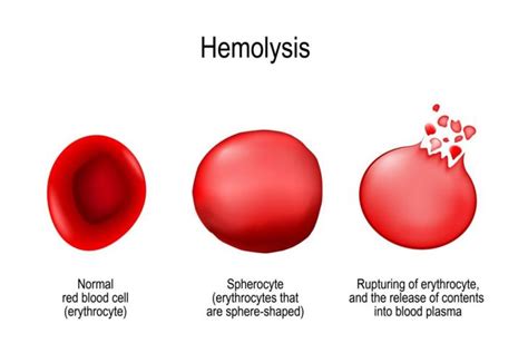 Causes Of High And Low Hemoglobin Levels Health And Detox And Vitamins