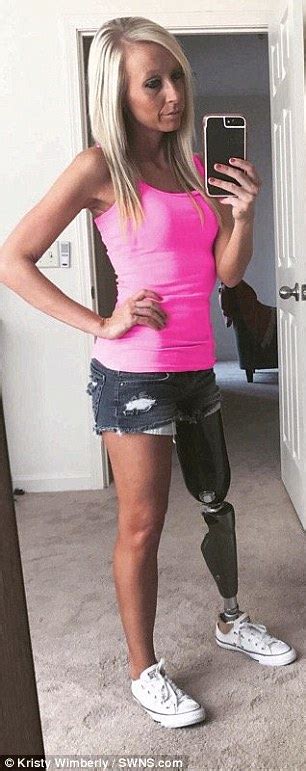 Kristy Wimberly Amputates Ugly Leg After Hiding It For 20 Years