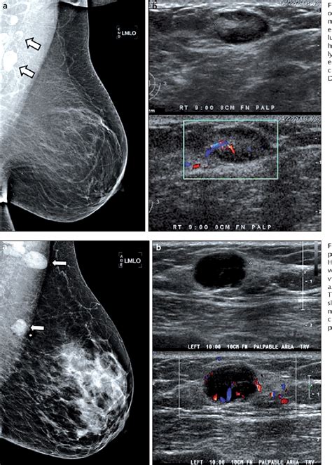 Pdf Abnormal Axillary Lymph Nodes On Negative Mammograms Causes Other Than Breast Cancer