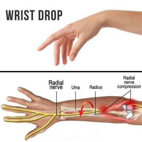 What Is Radial Nerve Palsy