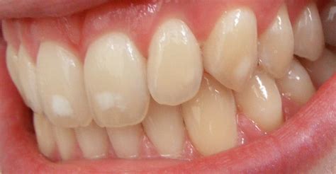 What Do White Spots On Your Teeth Mean How To Get Rid Of Them
