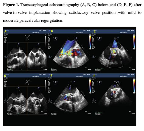Challenging Transfemoral Valve In Valve Implantation In A Degenerated