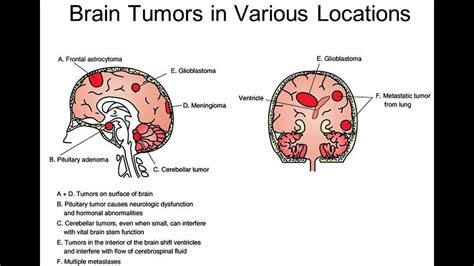 Brain Tumors Signs And Symptoms Youtube
