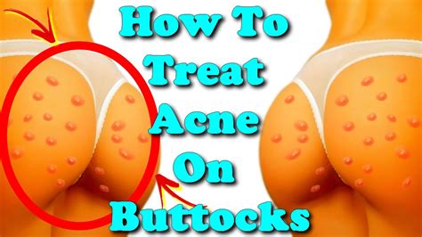 How To Treat Acne On Buttocks Youtube