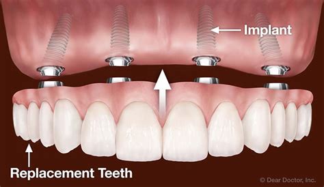 Dental Implants J A Lewandowski Dds Leawood Kansas