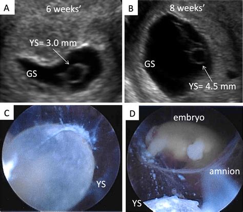 A Ultrasound And Hysteroscopic Images Of The Yolk Sac In A Partial