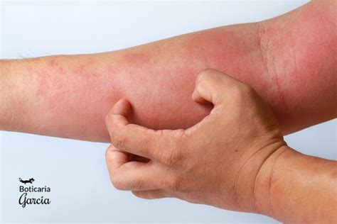 Dermatitis Atópica ¿en Qué Consiste Y Cómo Puedes Mejorarla