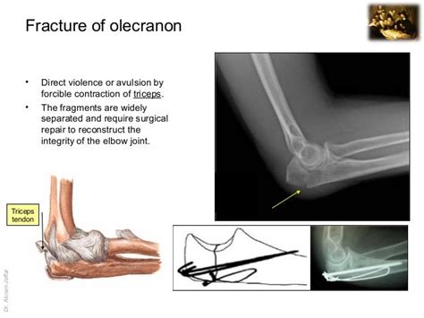 Olecranon Avulsion Fracture