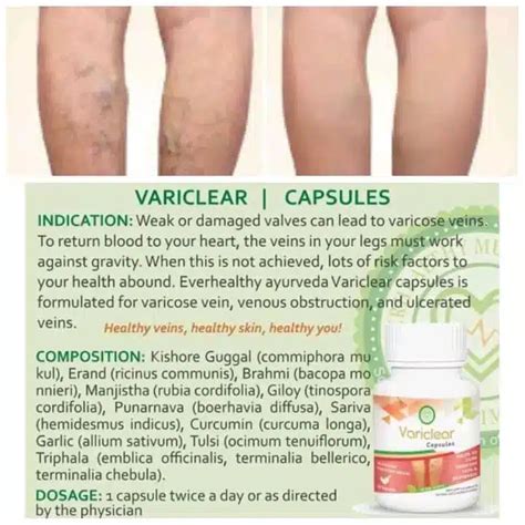 Variclear Capsules For Clearing Of Varicose Veins Pure Herbal Products