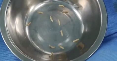 surgeons remove 50 live maggots from pensioner s face in extremely rare case world news