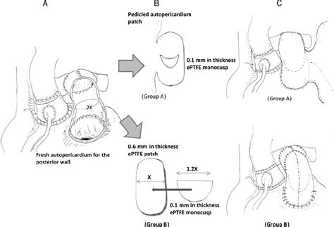 Right Ventricular Out Fl Ow Tract Reconstruction Procedures A A