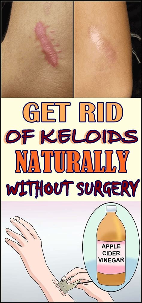 How To Remove Keloids Home Remedies Howtoremvo