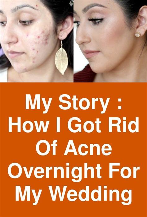 Pin On Acne Scars On Face