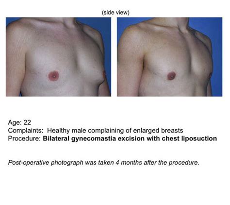 Gynecomastia Male Breast Reduction UF Health Plastic Surgery And