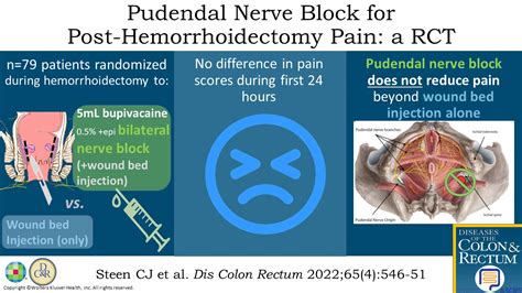 Pudendal Nerve Block For Posthemorrhoidectomy Pain A Prospe Diseases Of The Colon Rectum