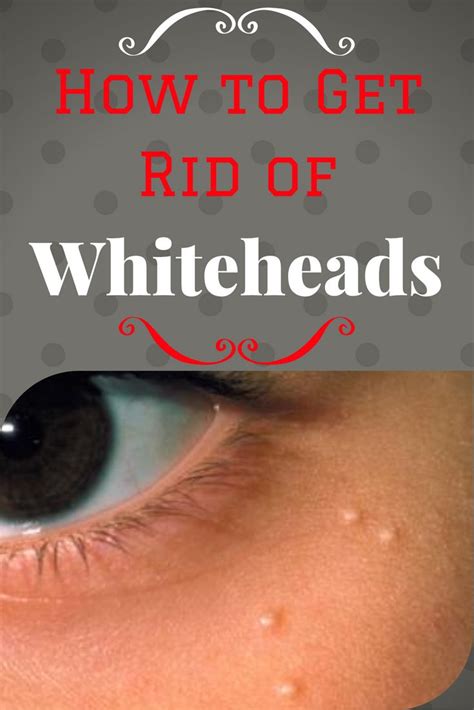 How To Get Rid Of Whiteheads By Whiteheads Get Rid Of