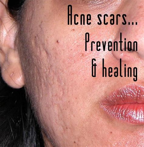 Skintherapy Ask The Esthetician Acne Scars And Marks