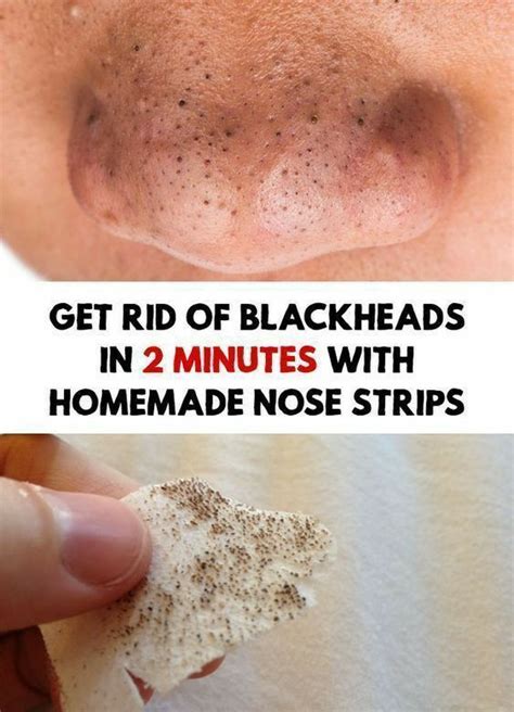How To Get Rid Of Blackheads On Nose Permanently Home Remedies Howtoremvo