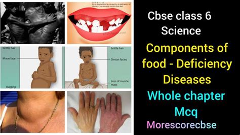 Cbse Class 6 Deficiency Diseases Mcq Deficiency Diseases Disease