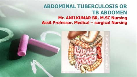 Tuberculosis Abdomen