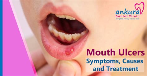 Mouth Ulcers Symptoms Causes And Treatment Mouth Sores