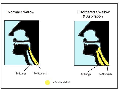 Swallowing Difficulties In Dementia Hull University Teaching