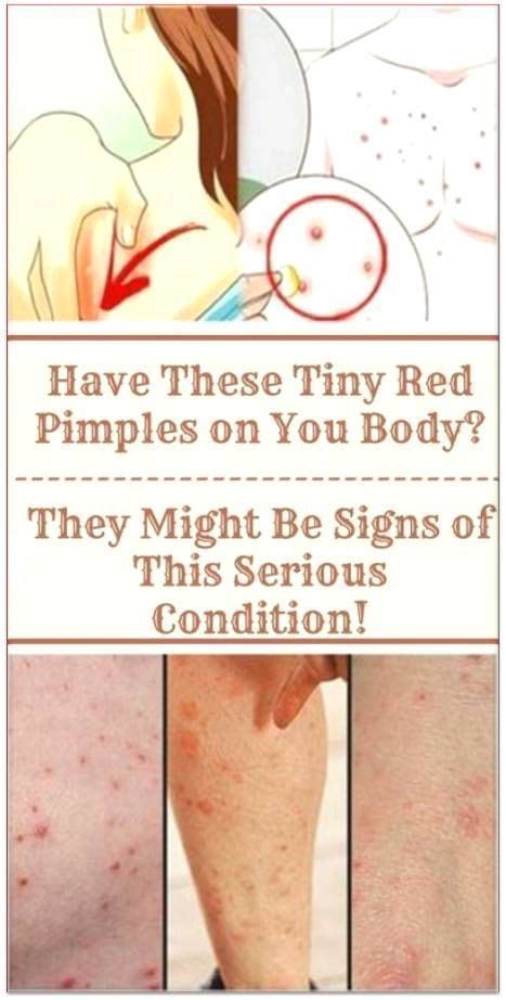 Have These Tiny Red Pimples On You Body They Might Be Signs Of This