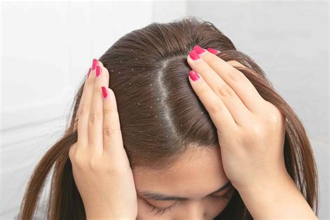 Flakes In Hair Causes Treatment And Prevention
