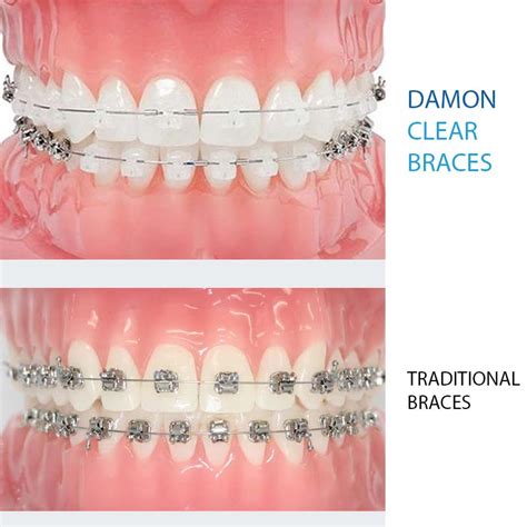 Damon Clear Braces Birchgrove Dental