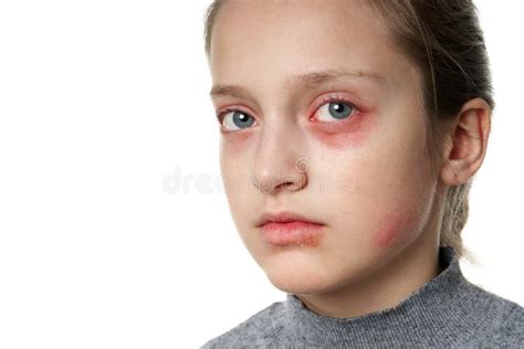 Portrait Proche De Vue Déruptions Cutanées De Réaction Allergique Dun