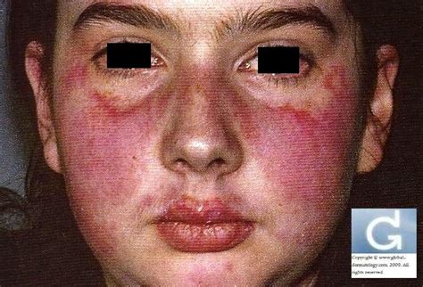 Lupus Erythematosus Globale Dermatologie