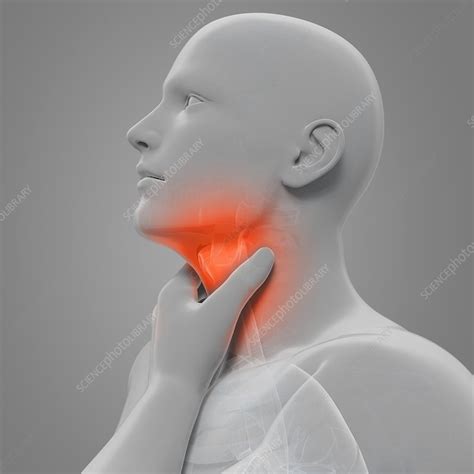 Sore Throat Artwork Stock Image F0076349 Science Photo Library