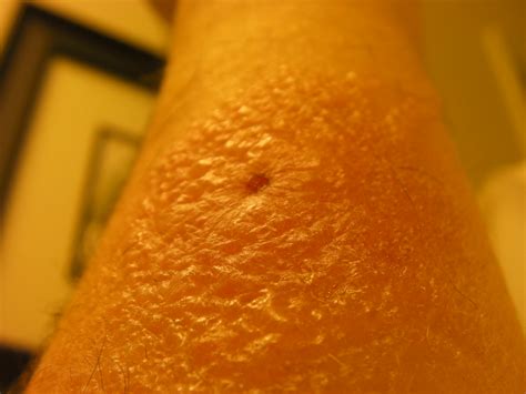 Spider Bite Day 6 Day 6 With The Brown Recluse Spider Bi Flickr