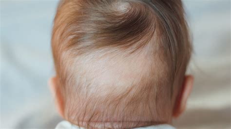 What It Really Means When Youre Born With A Bald Spot