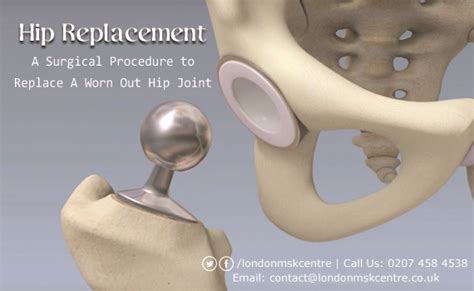 Hip Replacement London Musculoskeletal Centre Orthopedic And Sports Medicine