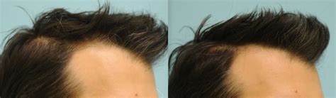Minoxidil Before And After Photos 2023 Is It Right For