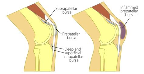 Housemaids Knee Or Prepatellar Bursitis What Can You Do About It