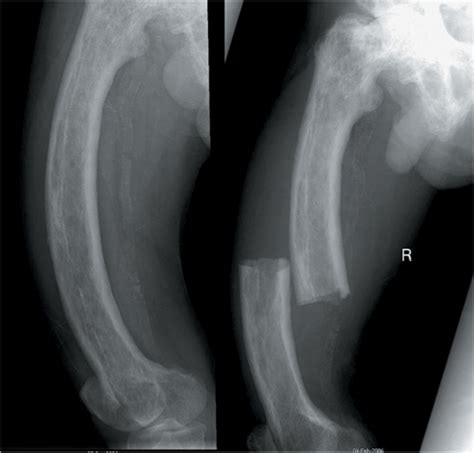 Femoral Diaphyseal Fractures Musculoskeletal Key