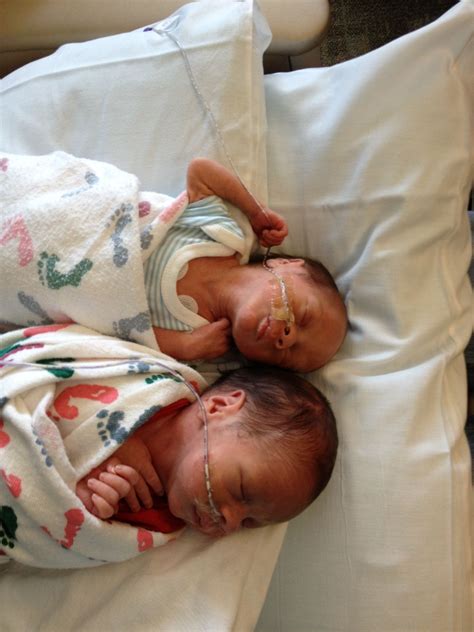 Twin To Twin Transfusion Syndrome Ttts Survivors Born At 32 Weeks 2lbs 11 Oz And 3lbs 14oz