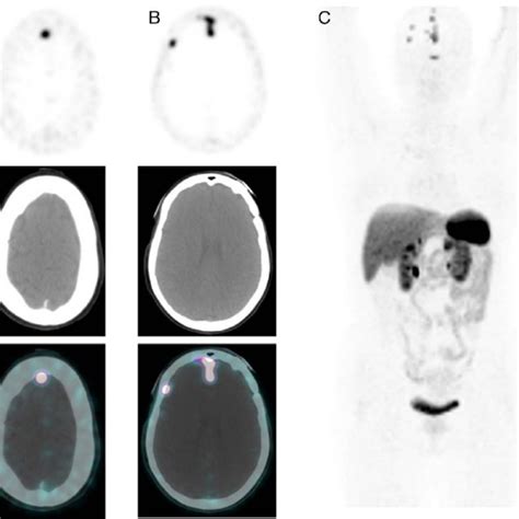 68 Ga Dotatoc Petct Axial Pet Ct Fused Petct A And B And Maximum