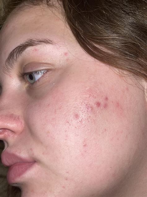 Acne Help Racne