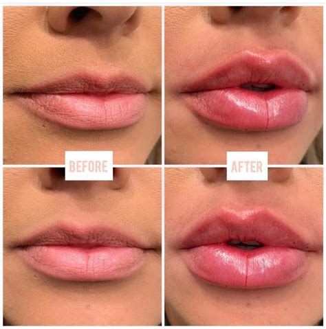 Lips By Linasev 1 Full Syringe Of Juvederm Ultra Xc Currently Taking