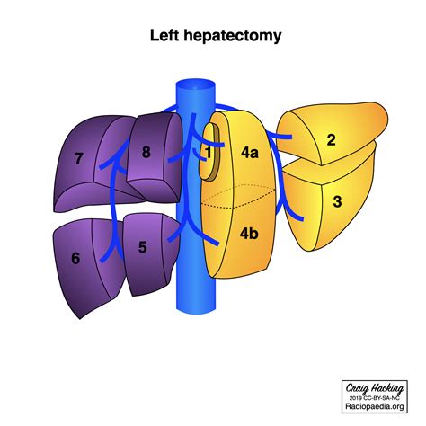 Hepatectomy And Sectionectomy Diagram Image